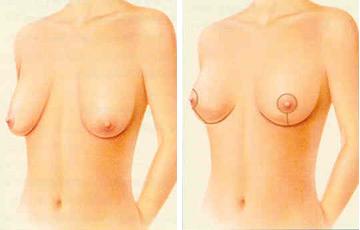 Breast Lift Surgery in Turkey