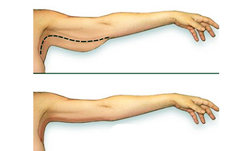 Arm Lift Surgery